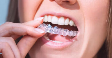 ¿Qué pasa con los alineadores dentales transparentes?